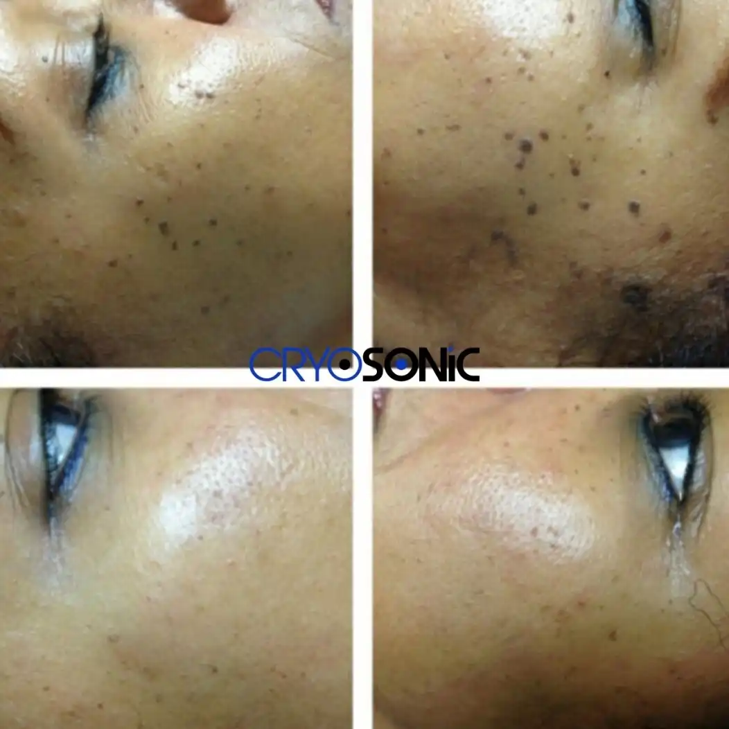 Why Skin Shows Pigmentation After Treatment Southend-on-Sea