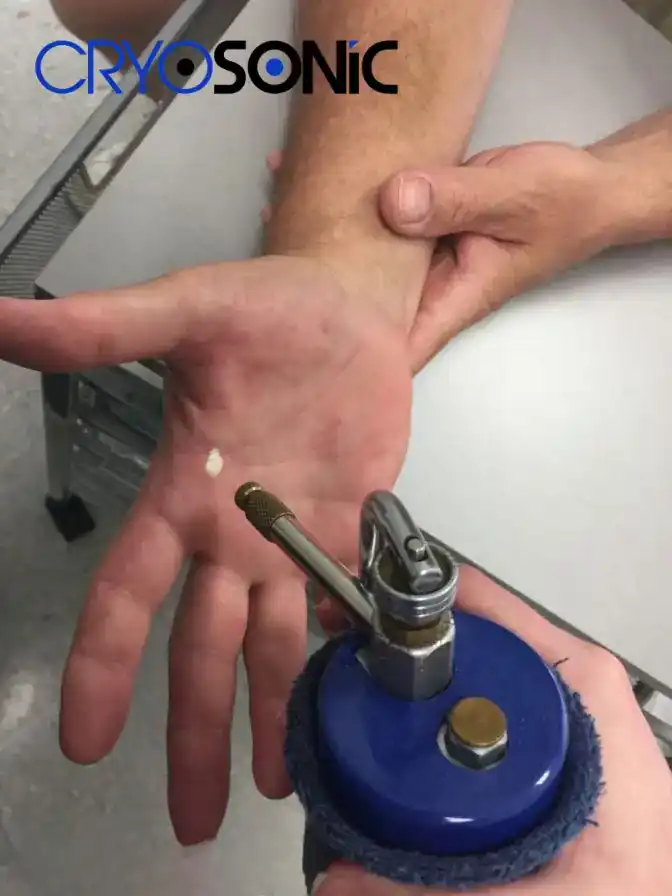 Temperature Differences: OTC vs Medical-Grade Cryotherapy Southend-on-Sea